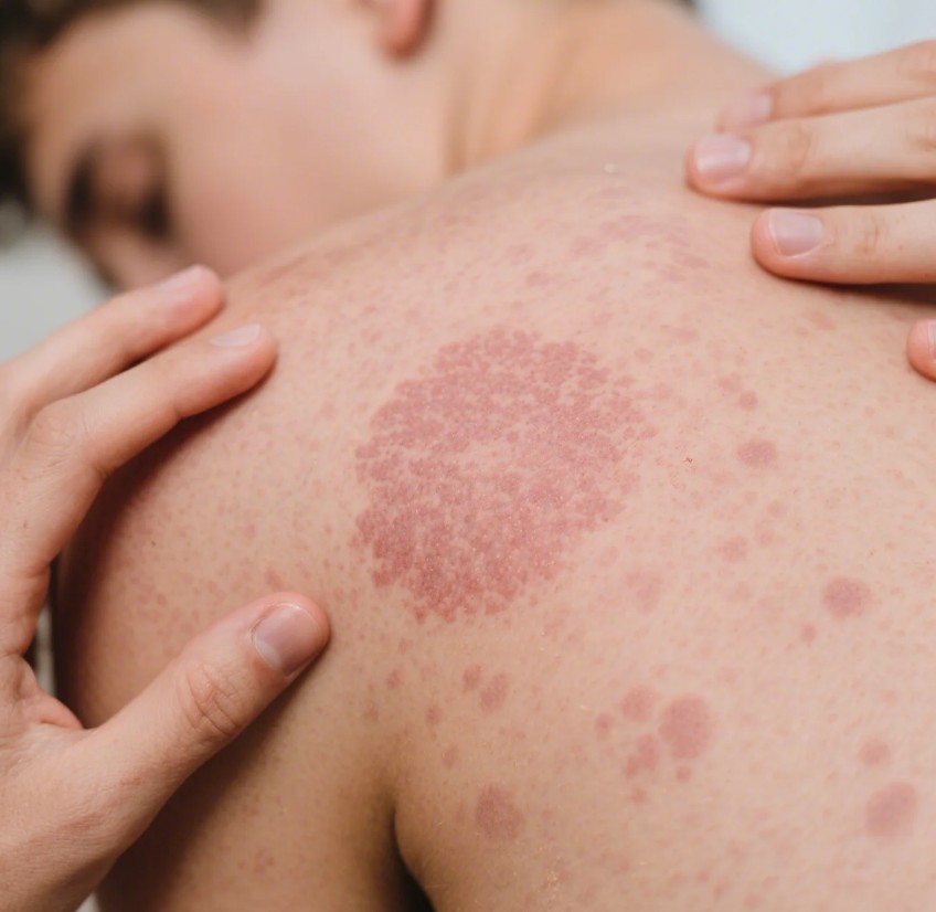 Pityriasis rosea, genellikle gençlerde ve orta yaşlı bireylerde görülen, ciltte döküntü şeklinde ortaya çıkan bir rahatsızlıktır.