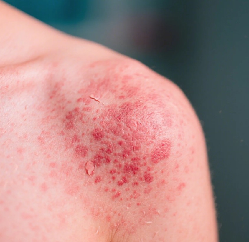 Pityriasis rosea