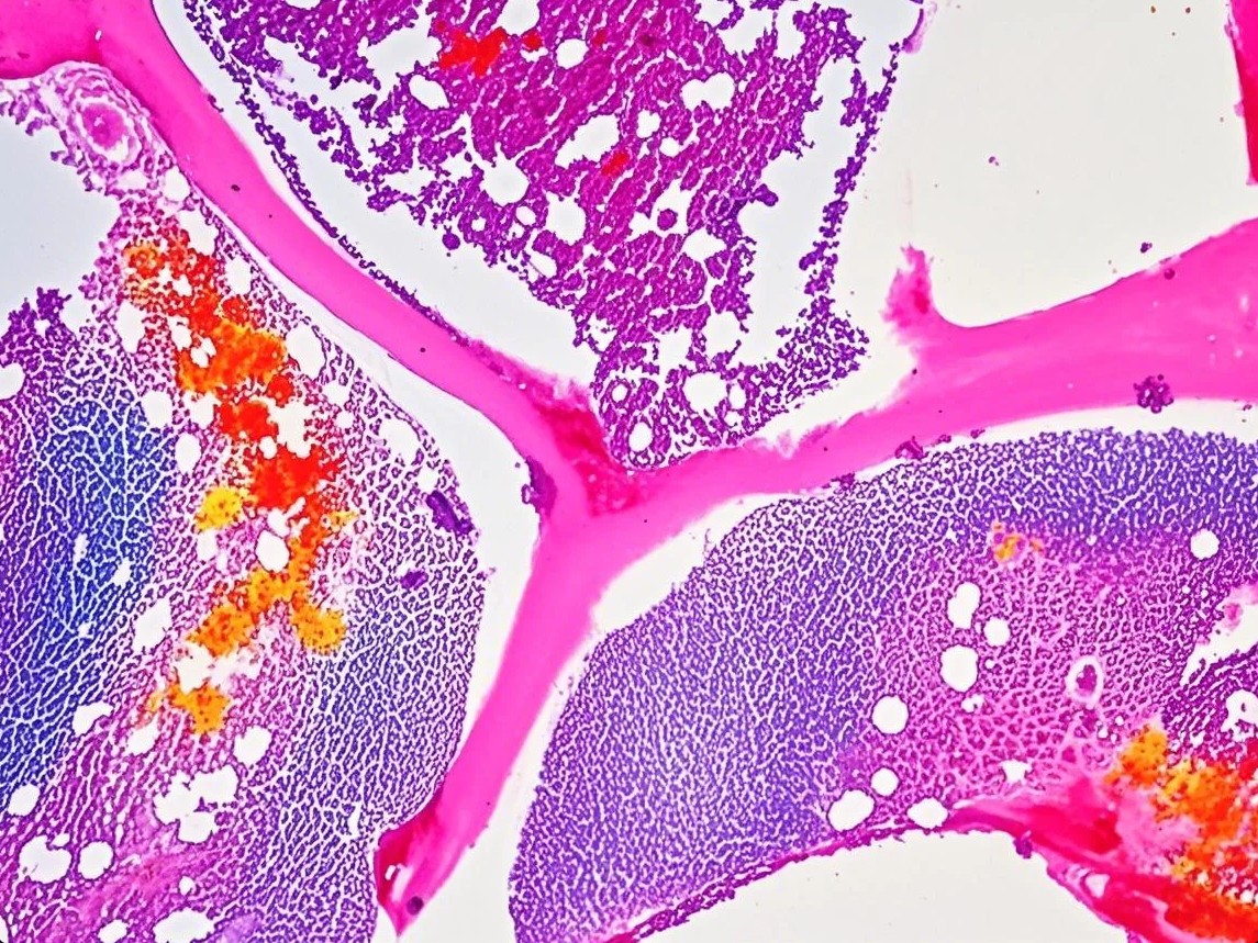 Bone marrow involvement in follicular lymphoma (FL)