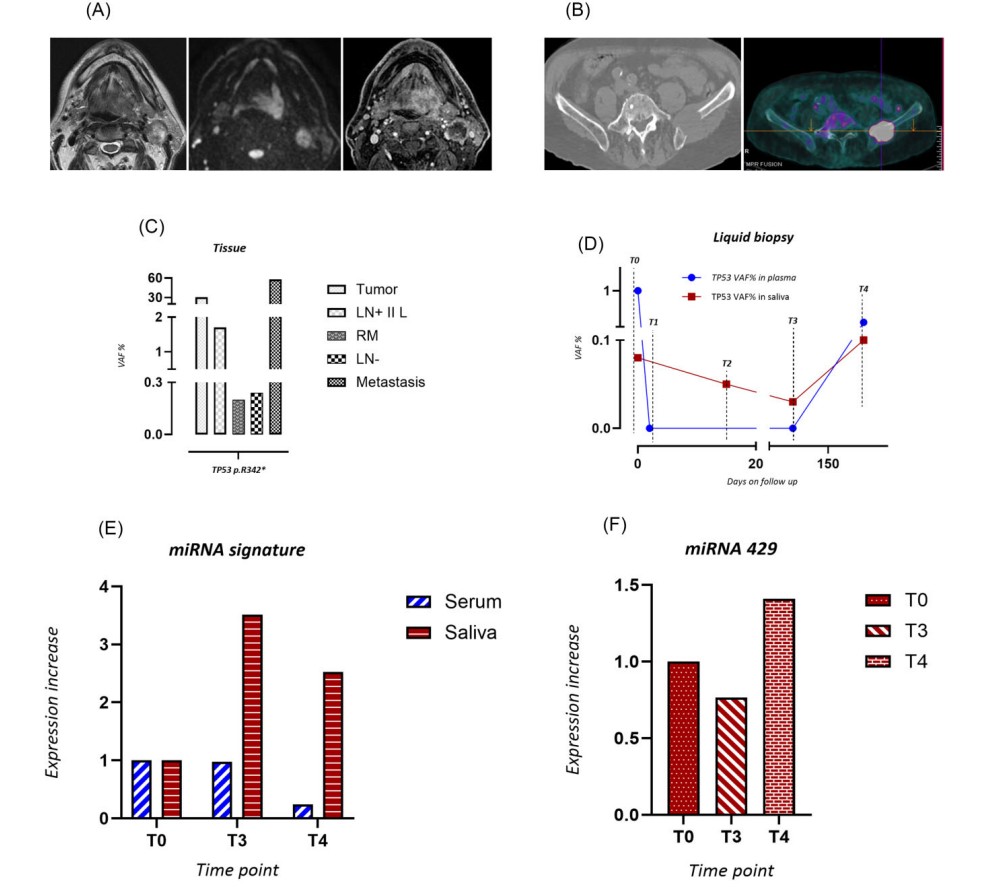 Liquid biopsy in head and neck cancer patients blood, saliva, or both