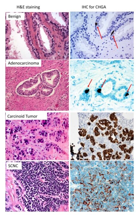 Neuroendocrine cells of the prostate