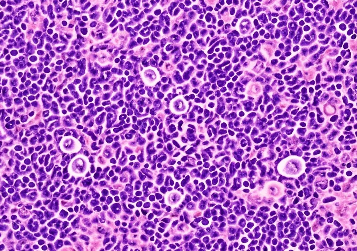 Nodular lymphocyte-predominant Hodgkin lymphoma