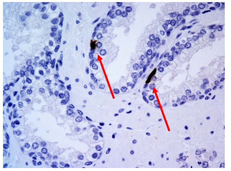 Small cell neuroendocrine carcinoma