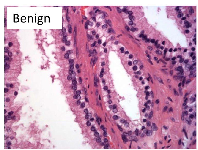 Small cell neuroendocrine carcinoma