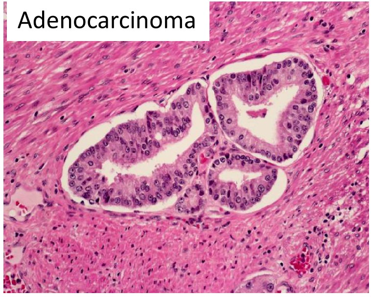 Small cell neuroendocrine carcinoma