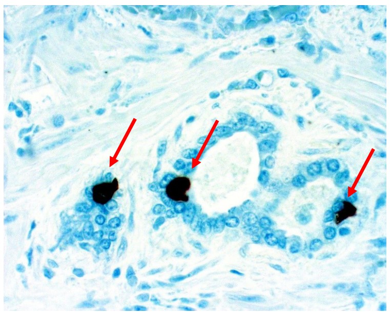 Small cell neuroendocrine carcinoma
