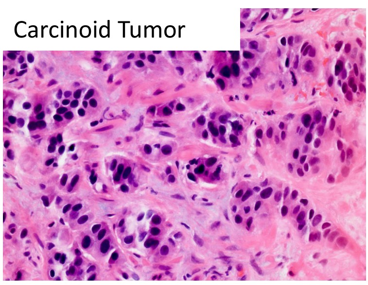 Small cell neuroendocrine carcinoma