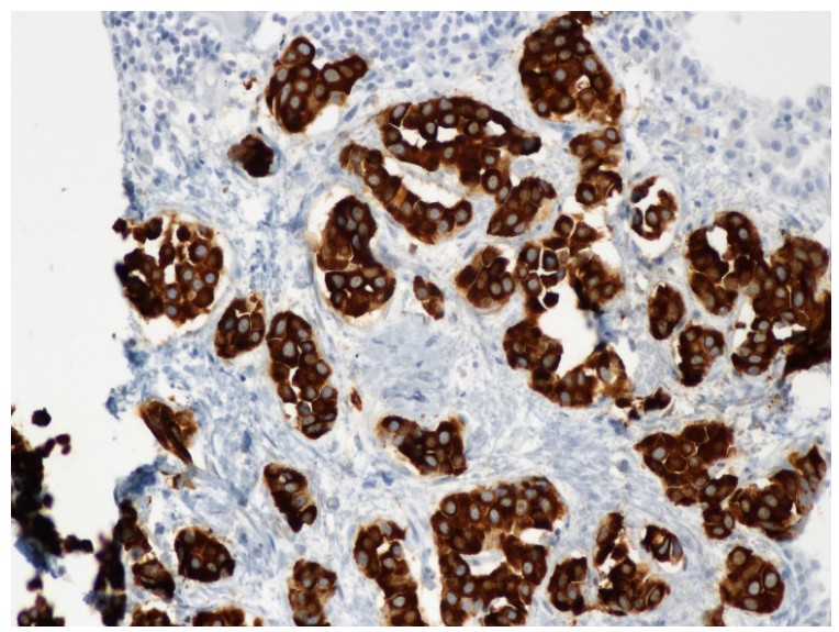 Small cell neuroendocrine carcinoma