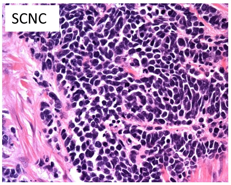 Small cell neuroendocrine carcinoma