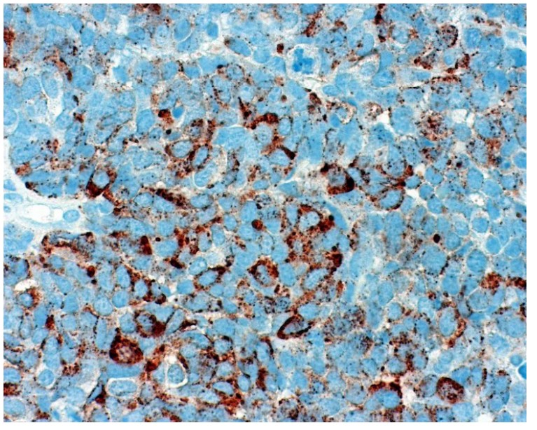 Small cell neuroendocrine carcinoma