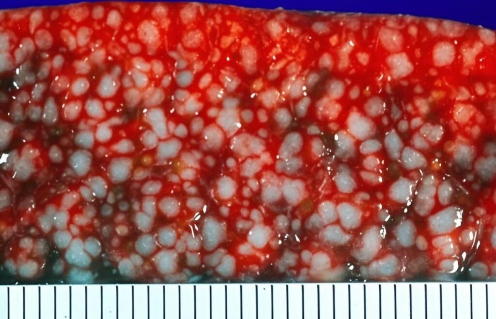 Splenic involvement in follicular lymphoma causes uniform enlargement of white pulp