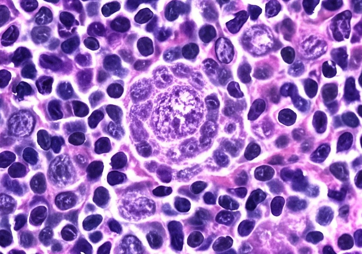 The center of this image shows a lymphocyte-predominant (LP) cell (aka popcorn cell) with multilobated