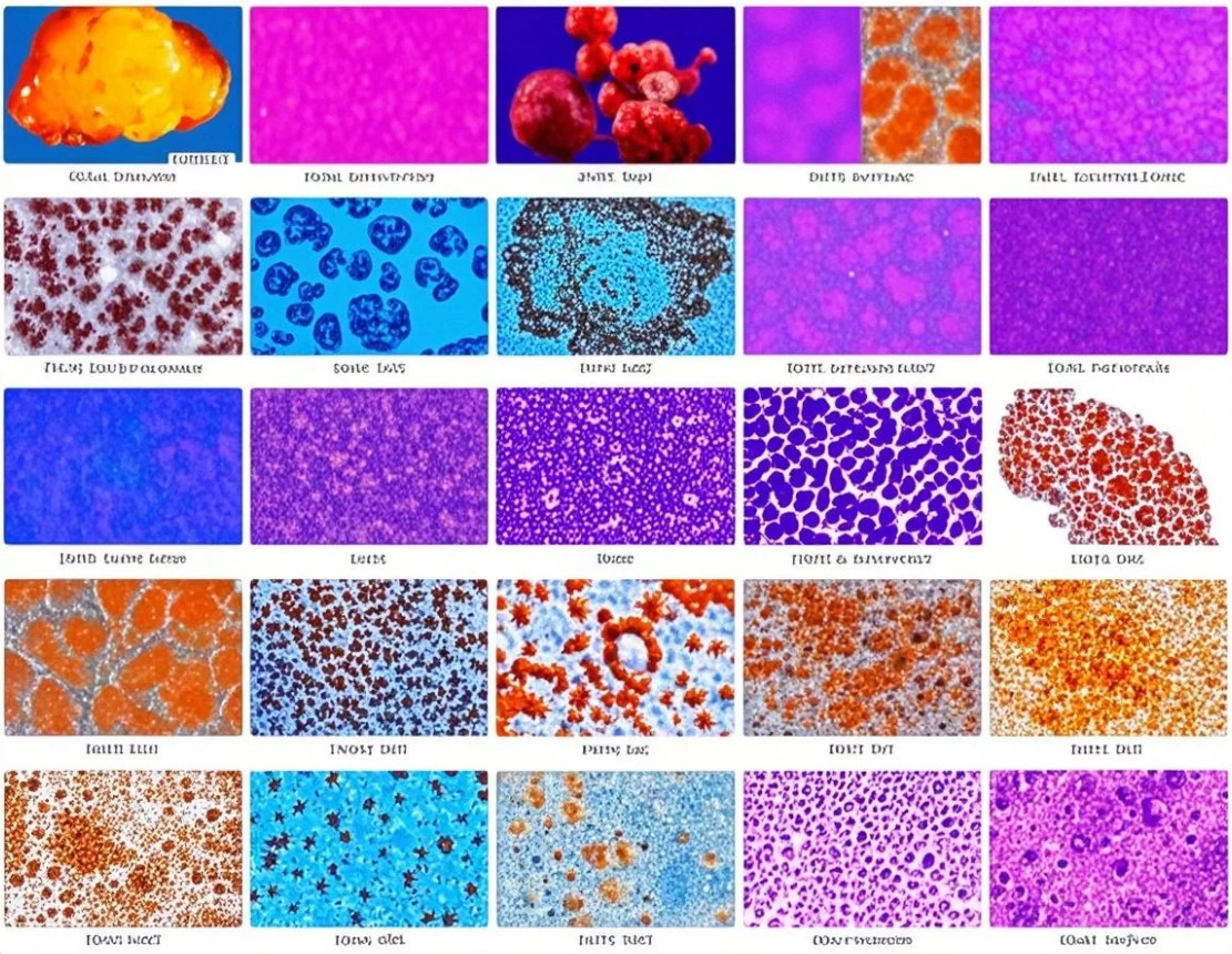 nodular-lymphocyte-pred-hodgkin-lymphoma
