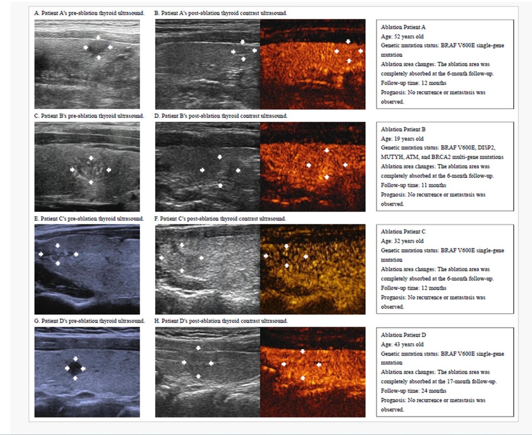 thyroid-contras-ultrasound